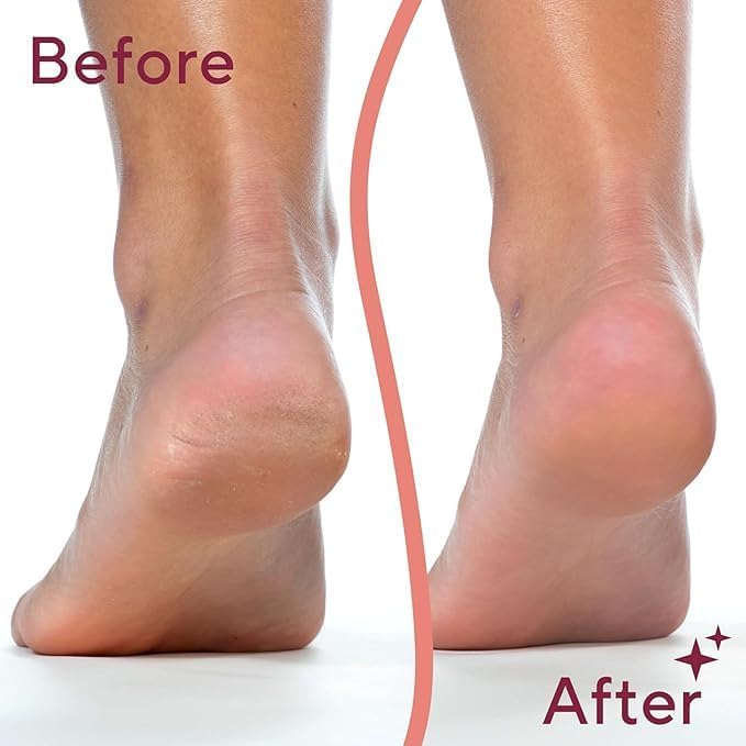 SPAREQUE Callus Remover for Feet – Rechargeable Pedicure Tool for Dead Skin & Cracked Heels