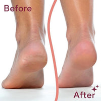 SPAREQUE Callus Remover for Feet – Rechargeable Pedicure Tool for Dead Skin & Cracked Heels